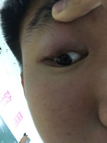 前几天起床的时候眼睛就有点肿了..然后几觉睡醒了之后,眼睛肿的就越来越严重了,一下是图片,我也