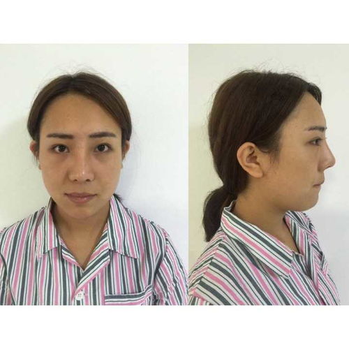 表情自体脂肪填充靠谱吗表情