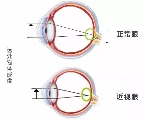 女孩3岁戴眼镜5岁近视300度除了看电视玩ipad,这个重要原因家长忽视了...