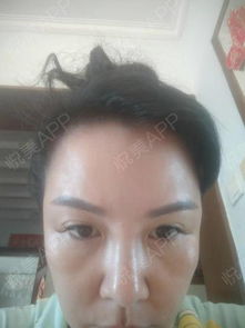 我现在是刚刚睡醒,刚刚照镜子的时候看到眼睛周围黄黄...去眼袋悦美整形