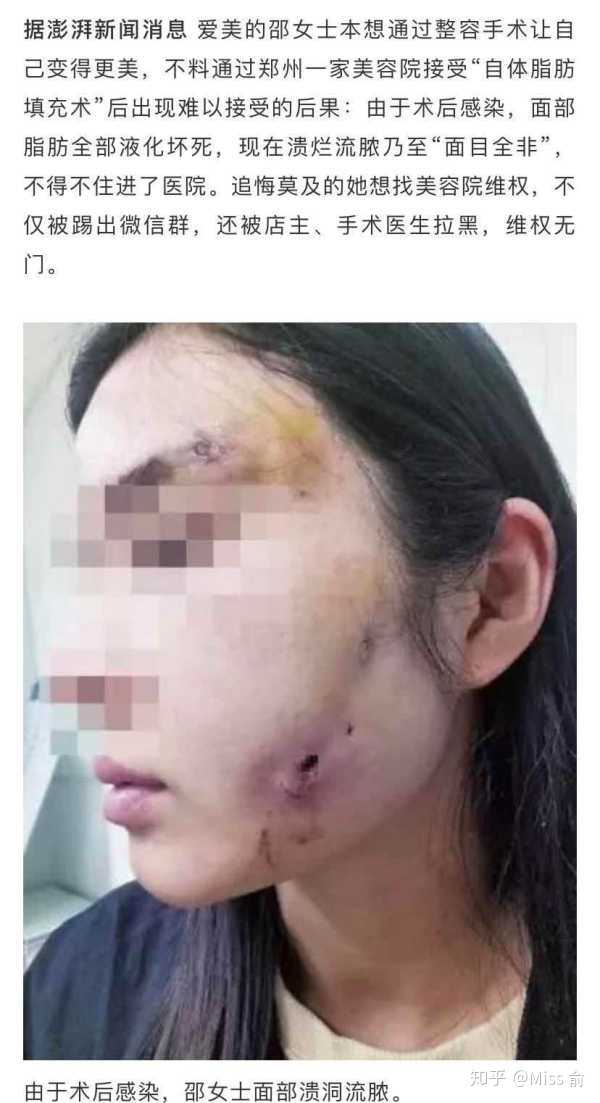 表情自体脂肪填充太阳穴需要多少钱啊表情