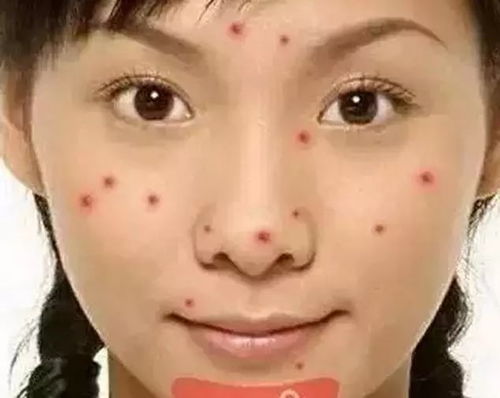 你的脸蛋反应了你的健康状况,老是长痘,到底是身体哪里生病了