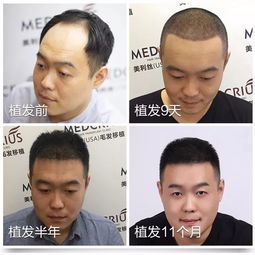年纪轻轻就脱发秃顶,原因究竟有哪些80后男子大胆尝试植发,结果大跌眼镜
