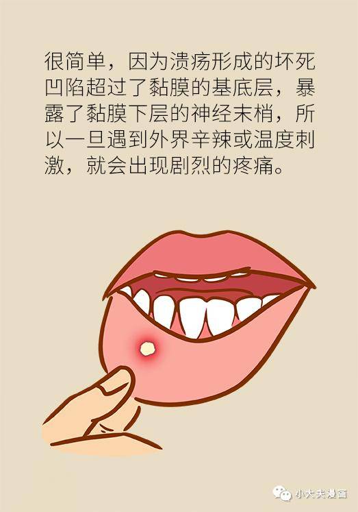 口腔溃疡反复发作可能是大病先兆,快去这些科室检查