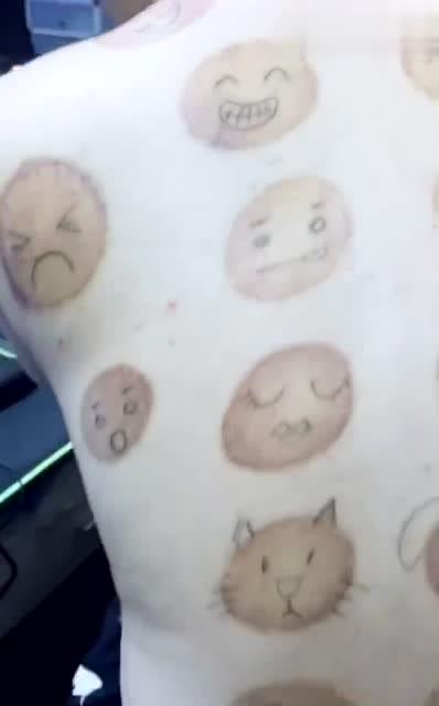 小哥这个拔火罐的印记做表情包简直太适合开心一刻