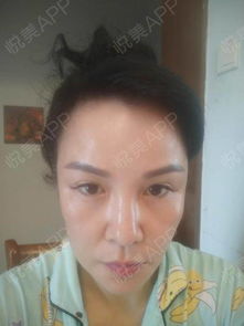 我现在是刚刚睡醒,刚刚照镜子的时候看到眼睛周围黄黄...去眼袋悦美整形