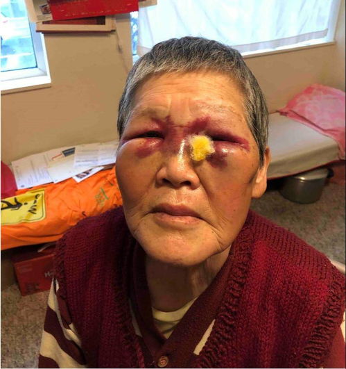 76岁华裔老太街头反击白人袭击者2万美国网友给其捐款治伤